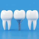 Dental Implants In Turkey 1